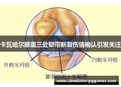 卡瓦哈尔膝盖三处韧带断裂伤情确认引发关注